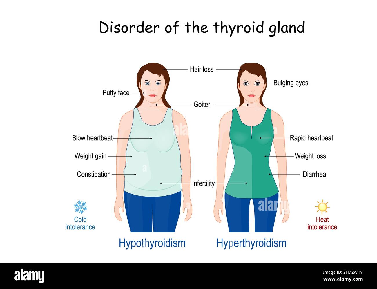Diferencia Entre Hipotiroidismo Y Hipertiroidismo